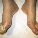 Gout Symptoms,  Causes, & Diagnosis